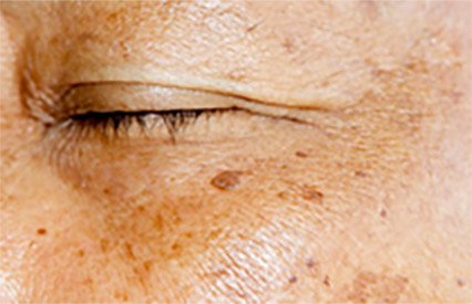 age spots symptom