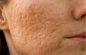 Acne Scarring
