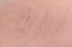 Tiny Spider Veins/Telangiectasia