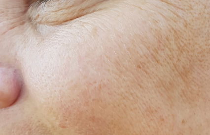 Uneven Skin Tone Texture