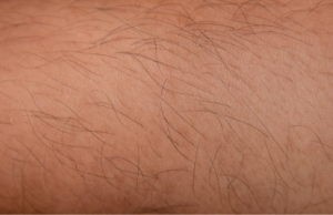 Unwanted Hair