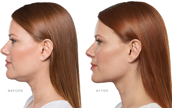 Kybella, Double Chin Treatment